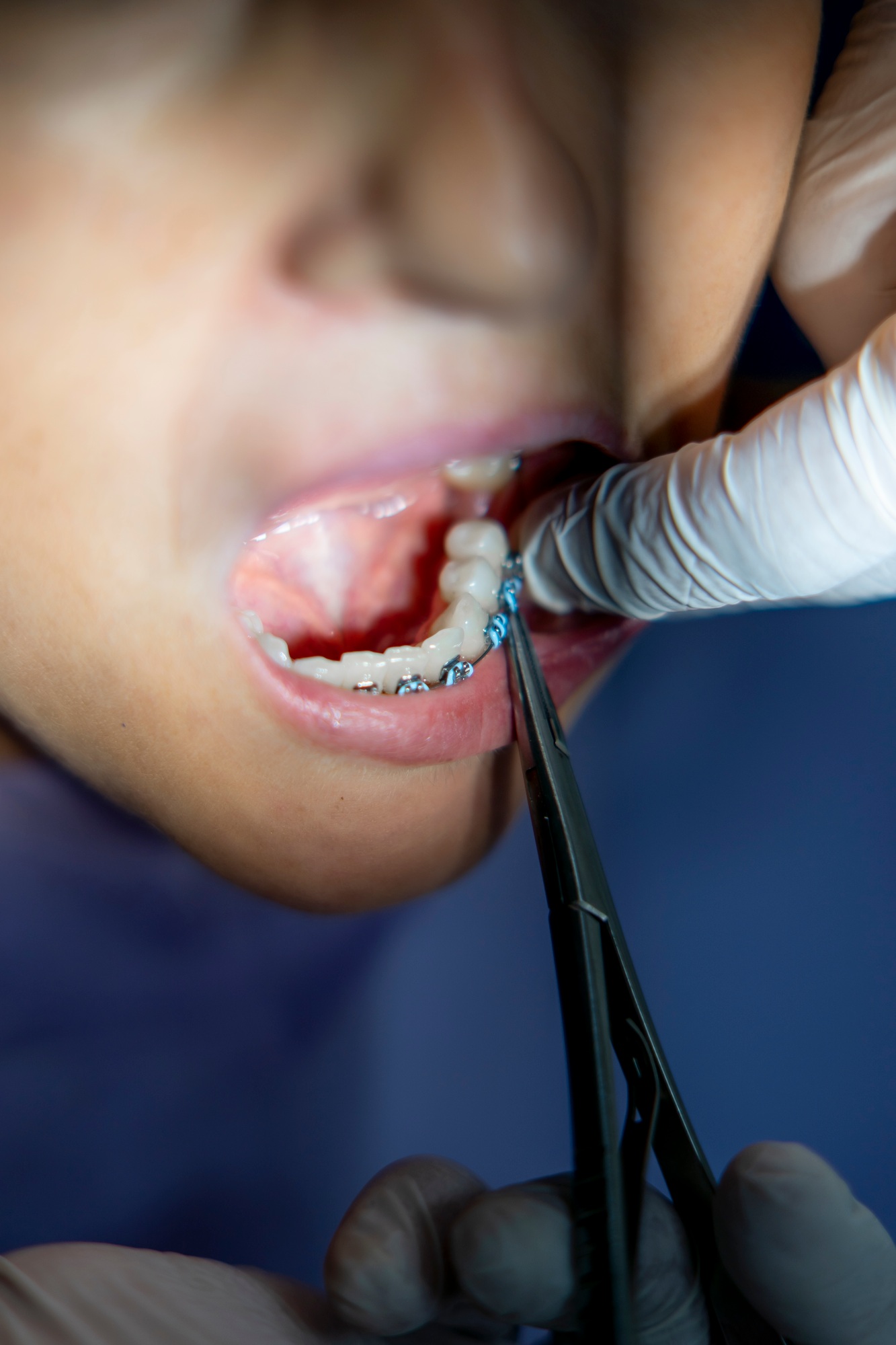 Woman at dentist placing braces on teeth