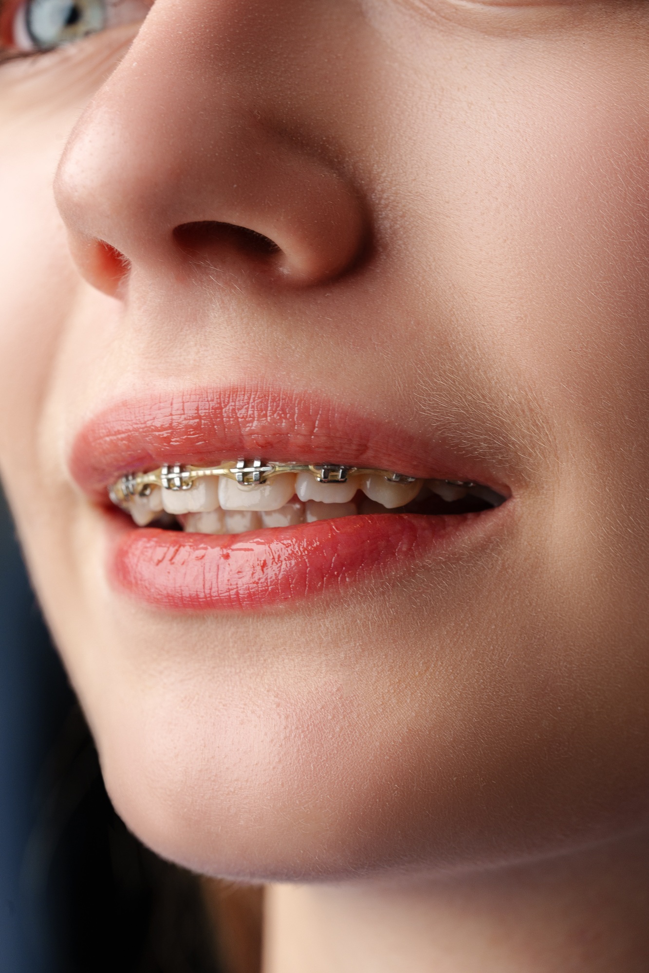 Young woman with dental braces close up
